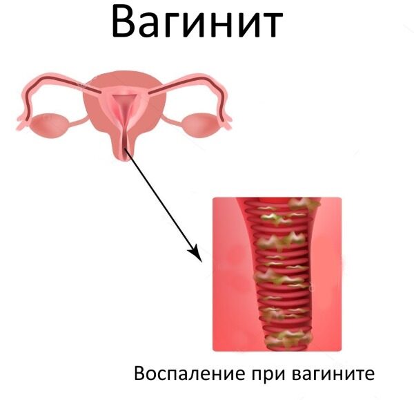 Крапива. Лечебные свойства, польза листьев, семян. Рецепты приготовления отвара, настойки, чай. Применение и противопоказания