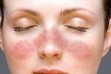 Туберкулезная волчанка - красные бугорки на коже лица