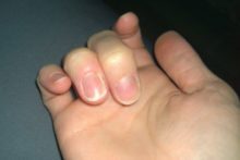 панариций под ногтем на бехымянном пальце руки, изменение цвета ногтя, отторжение ногтевой пластины